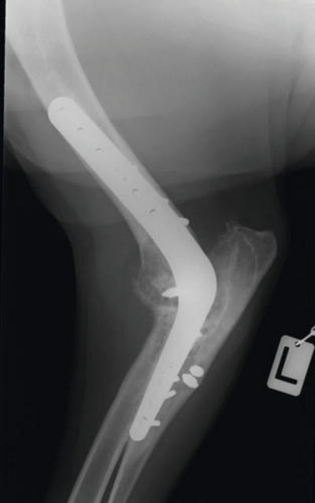 Ellbogen Arthrodeseplatte 3.5/2.7 rechts 152950