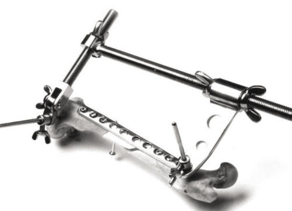 Orthopädischer Spreizer 330mm-001500