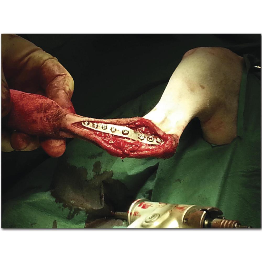 Intertarsale Hybrid-Arthrodese-Platte 2,7/3,5 mm