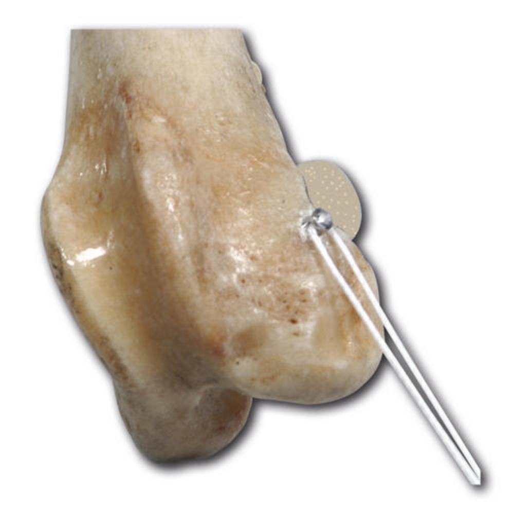 Ankerschraube, Ø2,5mm , 1mm Öse, 17mm Anker (SAP2.5)