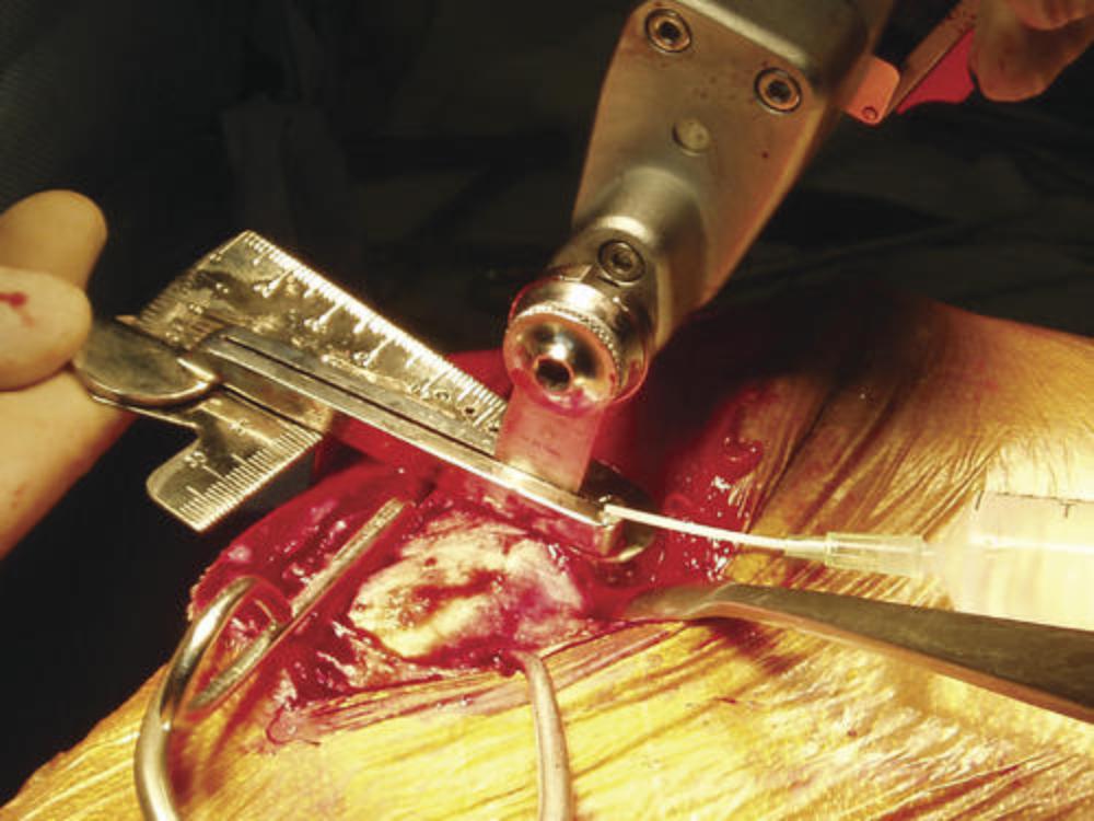 Basis Osteometer (TTO006)